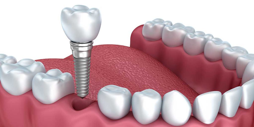 Many people nowadays opt for all-on-4 dental implants, but not all of them make educated choices in this respect. Let the best dental implants liverpool clinic address the most common errors to prevent dental implants all-on-4 type.